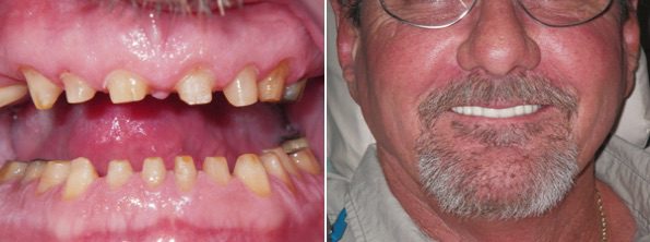 Crown and Bridge Before and After, Chemung Family Dental, Elmira NY 