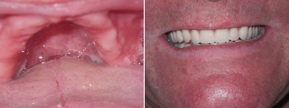 Dentures Before and After, Chemung Family Dental, Elmira NY 