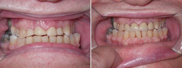 Front Crowns Before and After, Chemung Family Dental, Elmira NY 