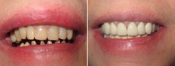 Veneers Before and After, Chemung Family Dental, Elmira NY 