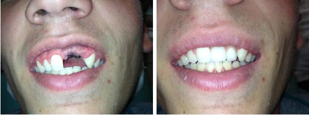 Upper Implant Crowns Before and After, Chemung Family Dental, Elmira NY 