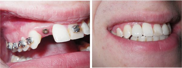 Upper Front Implants Before and After, Chemung Family Dental, Elmira NY 