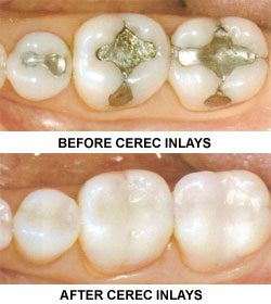 Cerek Inlays Before and After, Chemung Family Dental, Elmira NY 