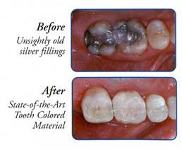 Fillings Before and After, Chemung Family Dental, Elmira NY 