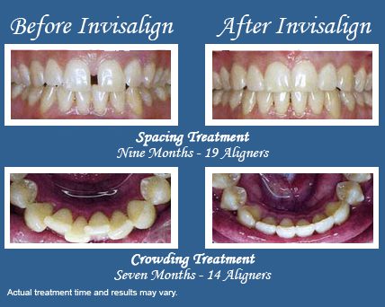 Invisalign Before and After, Chemung Family Dental, Elmira NY 