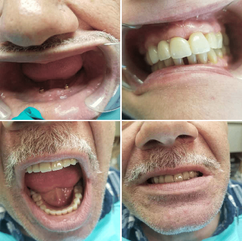 Teeth Restoration by Chemung Family Dental in Elmira, NY.