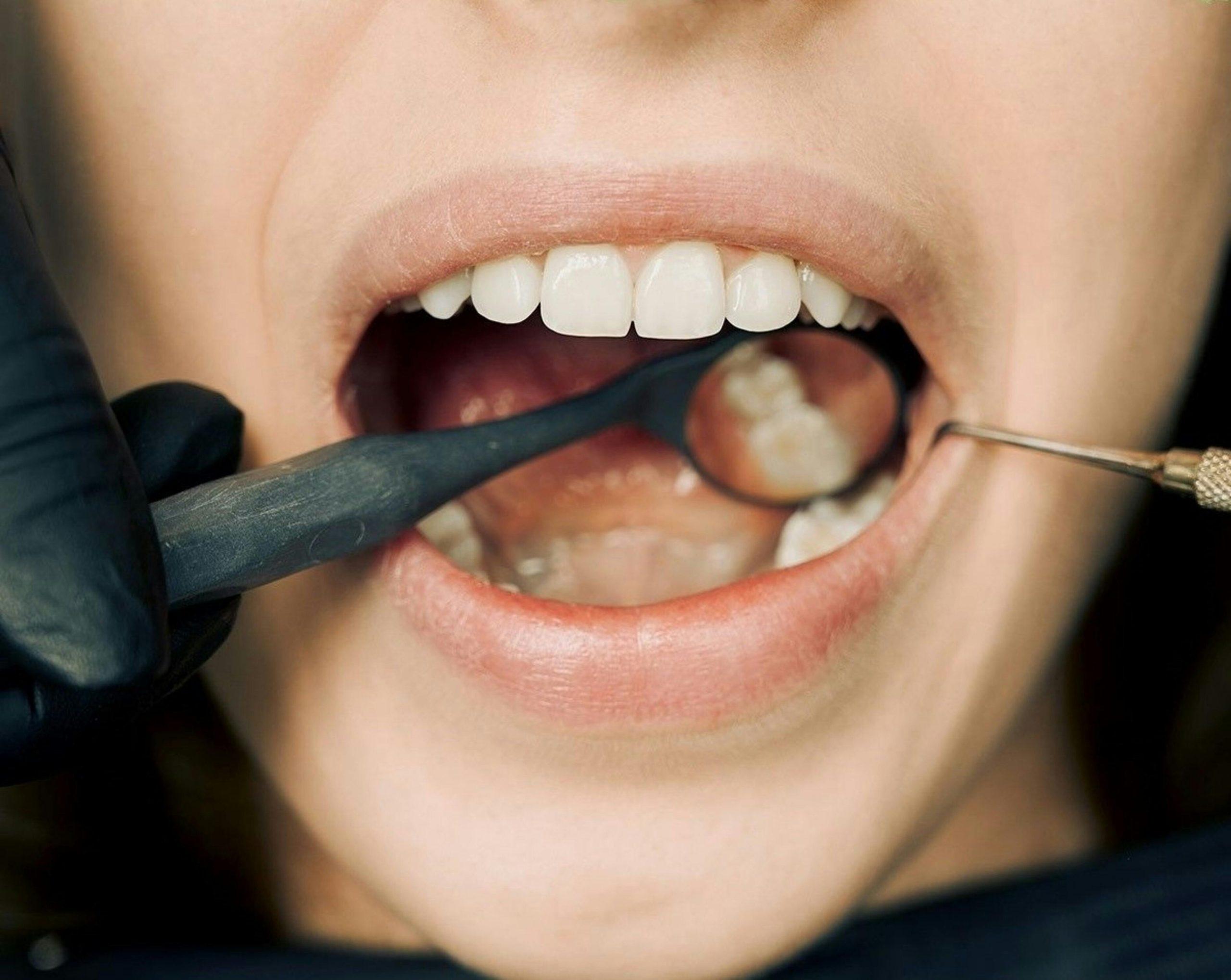 Patient receiving dental filling at Chemung Family Dental in Elmira, NY